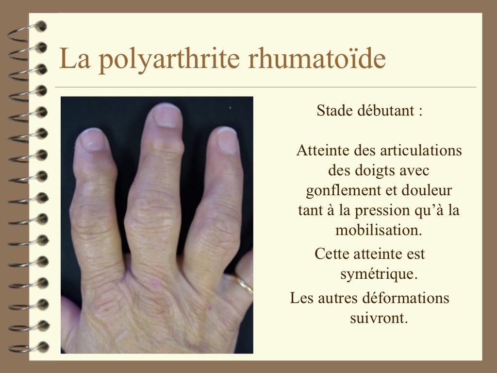 Maladies rhumatismales