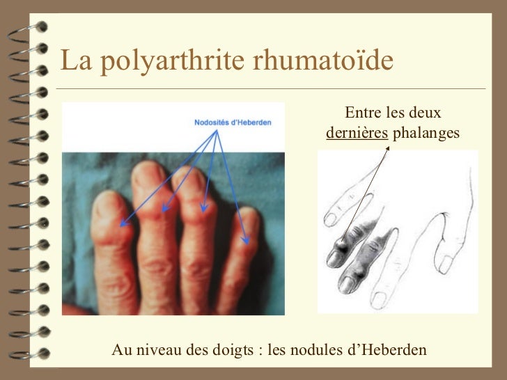Maladies rhumatismales