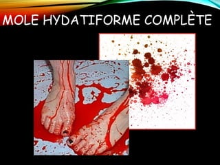 MOLE HYDATIFORME COMPLÈTE
 