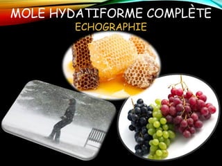 MOLE HYDATIFORME COMPLÈTE
ECHOGRAPHIE
 