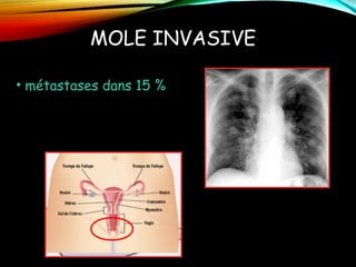 MOLE INVASIVE
• métastases dans 15 %
 