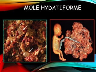 MOLE HYDATIFORME
 