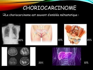 CHORIOCARCINOME
Le choriocarcinome est souvent d’emblée métastatique :
80% 30% 20%
20% 10%
 