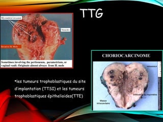 TTG
les tumeurs trophoblastiques du site
d’implantation (TTSI) et les tumeurs
trophoblastiques épithelioides(TTE).
 