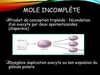 MOLE INCOMPLÈTE
Produit de conception triploïde : fécondation
d’un ovocyte par deux spermatozoïdes
(dispermie)
Dysgénie duplication ovocyte ou non expulsion du
globule polaire
 