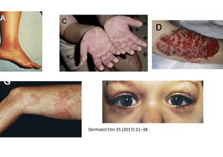 Diagnostic de syndrome de
ILARIS
• Tt: anti IL1• Tt: anti IL1
• Rémission
Diagnostic de syndrome de Muckle-Wells
 