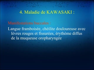 4. Maladie de KAWASAKI : Manifestations buccales : Langue framboisée, chéilite douloureuse avec lèvres rouges et fissurées, érythème diffus de la muqueuse oropharyngée 