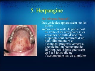 5. Herpangine  : An niveau buccal : Des vésicules apparaissent sur les piliers antérieurs du voile, la partie post du voile et les amygdales (Les vésicules de taille d’une tête d’épingle sont entourées d’un halo inflammatoire et s’étendent progressivement a une ulcération recouverte de fibrine). ces lésions guérissent en 3 a 5 jours elle ne s’accompagne pas de gingivite . 