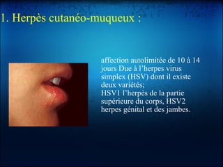 1. Herpès cutanéo-muqueux :   affection autolimitée de 10 à 14 jours Due à l’herpes virus simplex (HSV) dont il existe deux variétés; HSV1 l’herpès de la partie supérieure du corps, HSV2 herpes génital et des jambes. 
