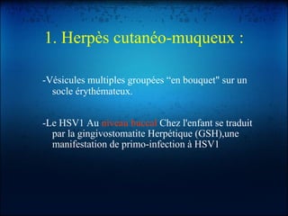1. Herpès cutanéo-muqueux : -Vésicules multiples groupées “en bouquet" sur un socle érythémateux. -Le HSV1 Au  niveau buccal  Chez l'enfant se traduit par la gingivostomatite Herpétique (GSH),une manifestation de primo-infection à HSV1 