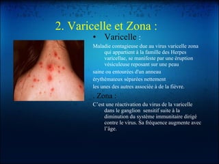 2. Varicelle et Zona   : Varicelle  : Maladie contagieuse due au virus varicelle zona qui appartient à la famille des Herpes varicellae, se manifeste par une éruption vésiculeuse reposant sur une peau saine ou entourées d'un anneau érythémateux séparées nettement les unes des autres associée à de la fièvre. . Zona : C’est une réactivation du virus de la varicelle dans le ganglion  sensitif suite à la diminution du système immunitaire dirigé contre le virus. Sa fréquence augmente avec l’âge. 