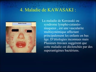 4. Maladie de KAWASAKI : -  La maladie de Kawasaki ou syndrome lympho-cutanéo-muqueux , est une vascularite multisystémique affectant principalement les enfants en bas âge. D’étiologies inconnues mais Plusieurs travaux suggèrent que cette maladie est déclenchée par des superantigènes bactériens. 
