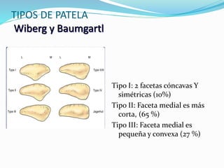 Wiberg Types Mal alineamiento patelofemoral | PPTX