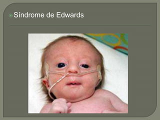  Síndrome   de Edwards
 
