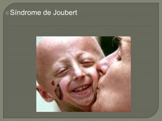  Síndrome   de Joubert
 