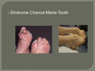  Síndrome   Charcot-Marie-Tooth
 