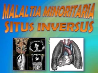 MALALTIA MINORITARIA SITUS INVERSUS : 