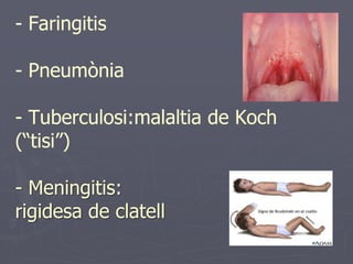 - Faringitis

- Pneumònia

- Tuberculosi:malaltia de Koch
(“tisi”)

- Meningitis:
rigidesa de clatell
 