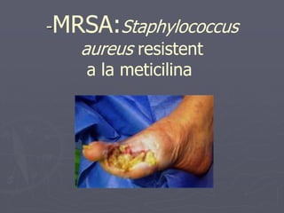 -MRSA:Staphylococcus
   aureus resistent
    a la meticilina
 