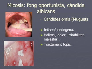 Micosis: fong oportunista, càndida
             albicans
              -   Candides orals (Muguet)

              ► Infecció  endògena.
              ► Halitosi, dolor, irritabilitat,
                malestar…
              ► Tractament tòpic.
 