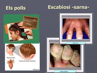 Els polls   Escabiosi -sarna-
 