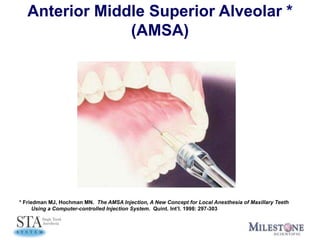 Anterior Middle Superior Alveolar *
(AMSA)
* Friedman MJ, Hochman MN. The AMSA Injection, A New Concept for Local Anesthesia of Maxillary Teeth
Using a Computer-controlled Injection System. Quint. Int’l. 1998: 297-303
 