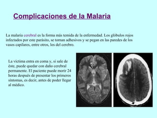 Complicaciones de la Malaria
La malaria cerebral es la forma más temida de la enfermedad. Los glóbulos rojos
infectados por este parásito, se tornan adhesivos y se pegan en las paredes de los
vasos capilares, entre otros, los del cerebro.
La víctima entra en coma y, si sale de
éste, puede quedar con daño cerebral
permanente. El paciente puede morir 24
horas después de presentar los primeros
síntomas, es decir, antes de poder llegar
al médico.
 