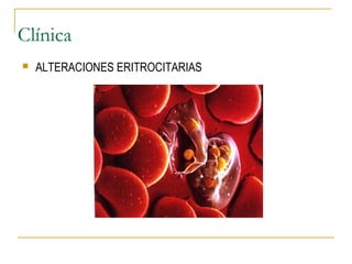 Clínica
 ALTERACIONES ERITROCITARIAS
 