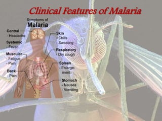 Clinical Features of Malaria
 