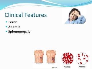 Clinical Features
 Fever
 Anemia
 Splenomegaly
 