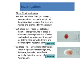 Investigations
Blood Film Examination
Thick and thin blood films (or “smears”)
have remained the gold standard for
the diagnosis of malaria. The films are
stained and examined by microscopy.
Thick blood film - Used for detecting
malaria: a larger volume of blood is
examined allowing detection of even
low levels of parasitaemia. Also used
for determining parasite density and
monitoring the response to treatment.
Thin blood film – Gives more information
about the parasite morphology and,
therefore, is used to identify the
particular infecting species of
Plasmodium.
Show Me
Show Me
 