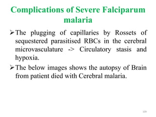 Complications of Severe Falciparum
malaria
The plugging of capillaries by Rossets of
sequestered parasitised RBCs in the cerebral
microvasculature -> Circulatory stasis and
hypoxia.
The below images shows the autopsy of Brain
from patient died with Cerebral malaria.
109
 