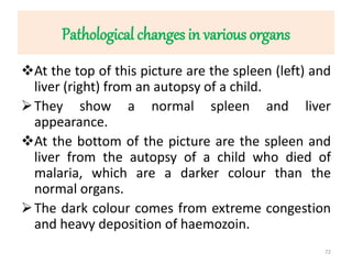 Pathological changes in various organs
At the top of this picture are the spleen (left) and
liver (right) from an autopsy of a child.
They show a normal spleen and liver
appearance.
At the bottom of the picture are the spleen and
liver from the autopsy of a child who died of
malaria, which are a darker colour than the
normal organs.
The dark colour comes from extreme congestion
and heavy deposition of haemozoin.
72
 
