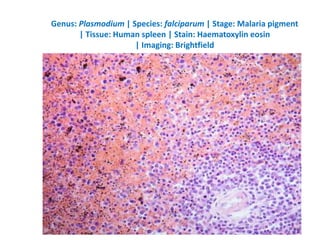 Genus: Plasmodium | Species: falciparum | Stage: Malaria pigment
| Tissue: Human spleen | Stain: Haematoxylin eosin
| Imaging: Brightfield
73
 
