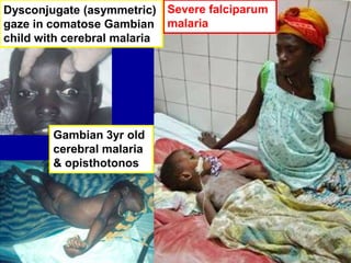 Severe falciparum
malaria
Gambian 3yr old
cerebral malaria
& opisthotonos
Dysconjugate (asymmetric)
gaze in comatose Gambian
child with cerebral malaria
 