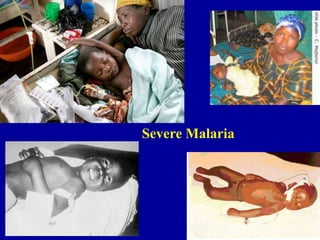 Severe Malaria
 