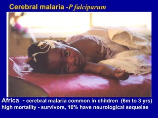 Cerebral malaria -P falciparum
Africa - cerebral malaria common in children (6m to 3 yrs)
high mortality - survivors, 10% have neurological sequelae
 