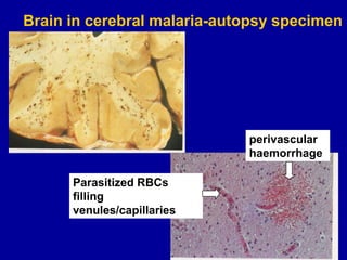 Brain in cerebral malaria-autopsy specimen
perivascular
haemorrhage
Parasitized RBCs
filling
venules/capillaries
 