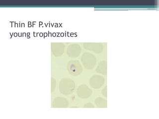 Thin BF P.vivax
young trophozoites
 