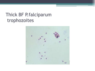 Thick BF P.falciparum
 trophozoites
 