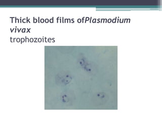 Thick blood films ofPlasmodium
vivax
trophozoites
 