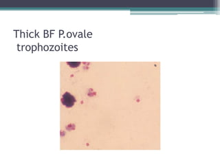 Thick BF P.ovale
 trophozoites
 