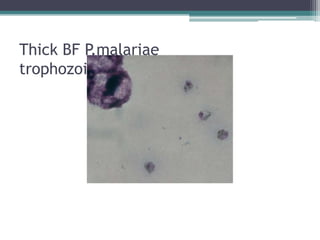 Thick BF P.malariae
trophozoites
 