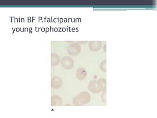 Thin BF P.falciparum
 young trophozoites
 