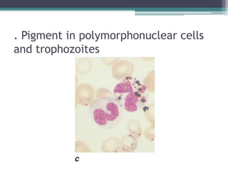 . Pigment in polymorphonuclear cells
and trophozoites
 