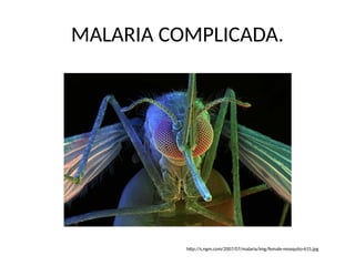 MALARIA COMPLICADA.
http://s.ngm.com/2007/07/malaria/img/female-mosquito-615.jpg
 