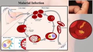 Malarial Infection
 