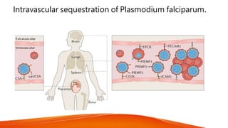 Intravascular sequestration of Plasmodium falciparum.
 