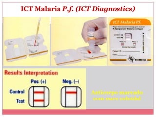 ICT Malaria P.f. (ICT Diagnostics)

Anticorpo marcado
com ouro coloidal

 