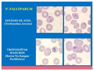 P. FALCIPARUM

ESTÁGIO DE ANEL
(Trofozoítas Jovens)

TROFOZOÍTAS
MADUROS
(Raros No Sangue
Periférico)

 